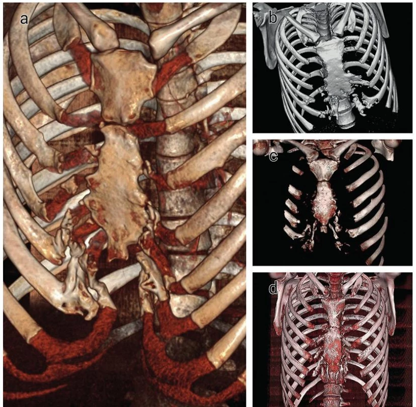 Kostná novotvorba v chrupavkách rebier u pacientov s recidívou pectus excavatum (3D-CT)
Fig. 3. Ossification of the costal cartilages in patients with recurrent pectus excavatum (3D-CT reformation)