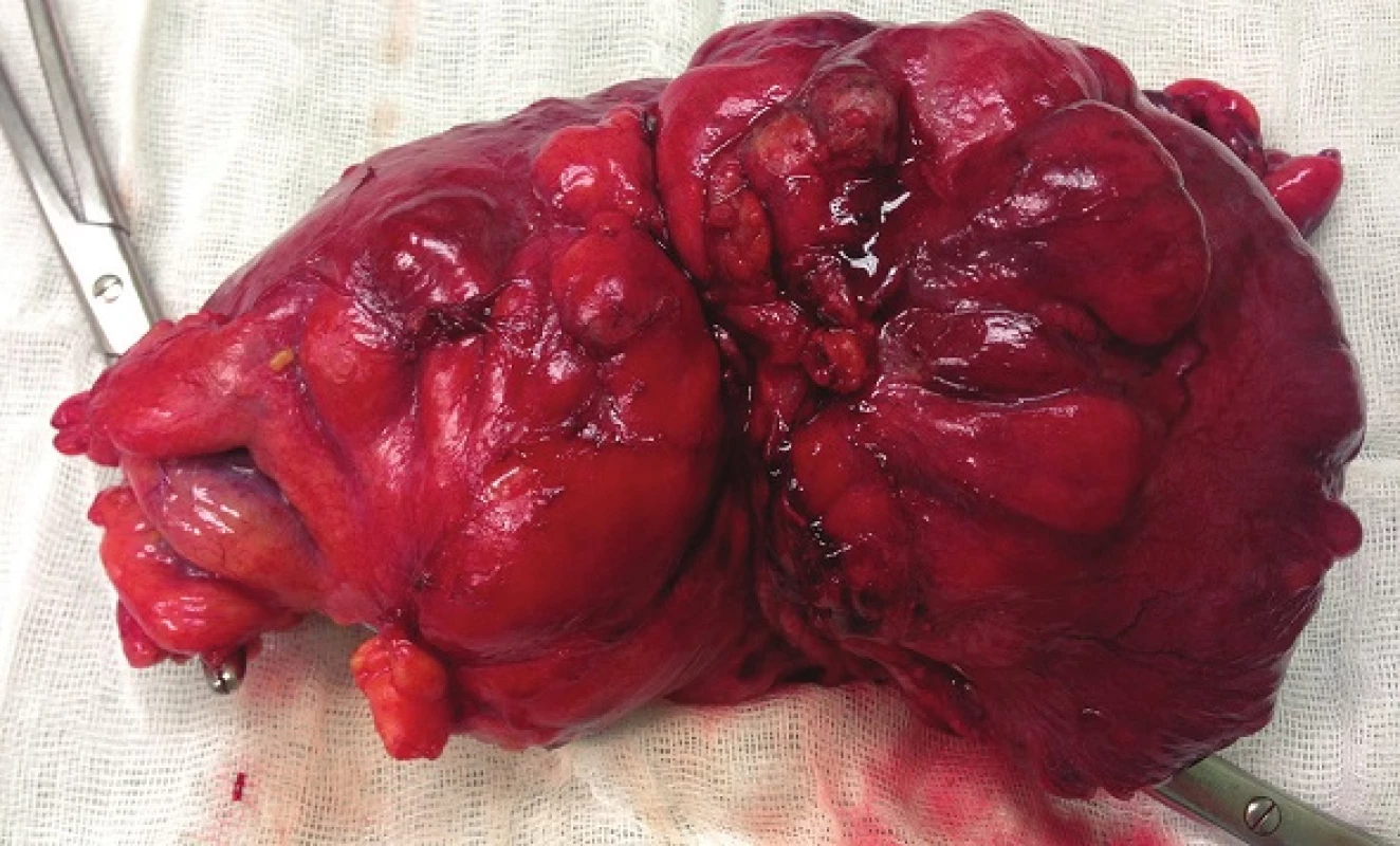 Resekát colon sigmoideum
Fig. 4: Resected sigmoid colon
