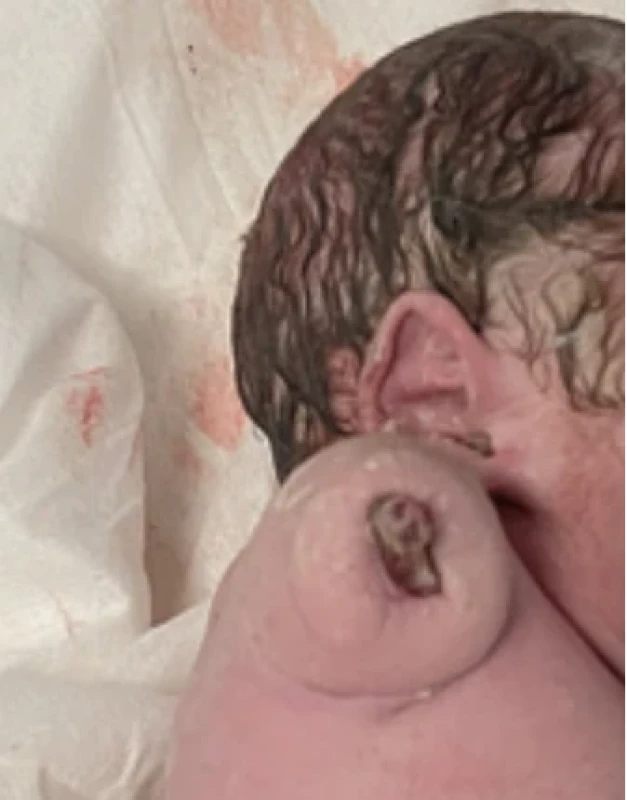 Pahýl pažní kosti u novorozence po porodu. Fig. 2. Humerus stump in a newborn after birth.