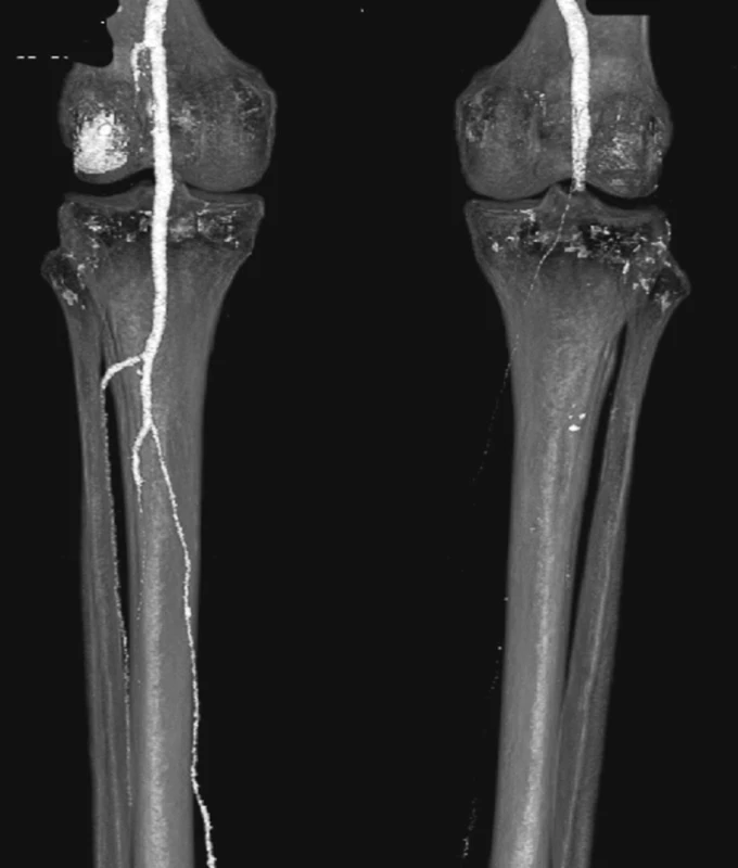 CTA obraz embolie do podkolenní tepny vpravo
Fig. 14: CTA image embolism in the right popliteal artery