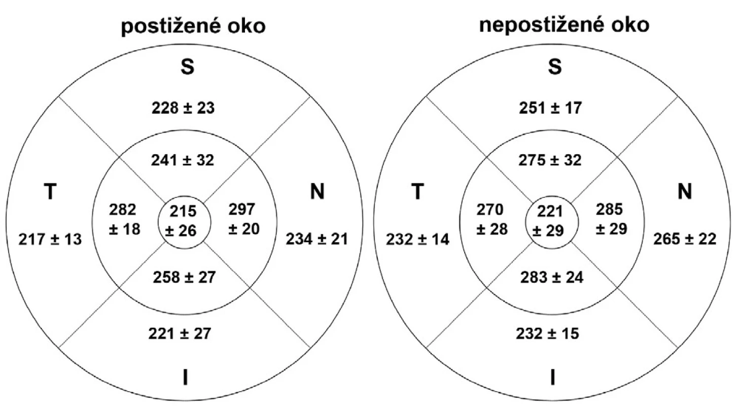 Tloušťka vrstvy nervových vláken v makule při kontrolním vyšetření nejméně za 3 měsíce po akutní atace AION v jednotlivých oblastech u postiženého a nepostiženého oka (S = superior = horní, I = inferior = dolní, N = nasal = nazální,T = temporal = temporální)