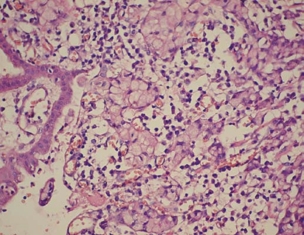 Signet ring cell karcinom žalúdka (Pat. anat. odd., Onkol. ústav sv. Alžbety, Bratislava).
Fig. 1. Signet ring cell carcinoma of the stomach (Pat. anat. dept., Oncol. institute of St. Elizabeth, Bratislava).
