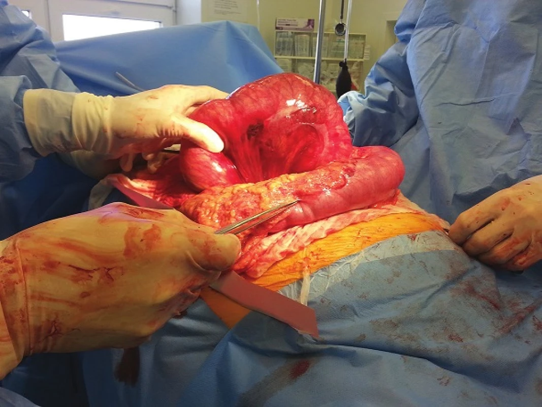 Peroperační snímek – situace po protětí ligamentum gastrocolicum (Pinzeta ukazuje na c. transversum, v levé ruce chirurga cékum a c. ascendent.)
Fig. 3: Intraoperative image – situation after the division of gastrocolic ligament (With tweezers pointing to c. transversum, and the surgeon´s left hand holding the cecum and c. ascendent.)