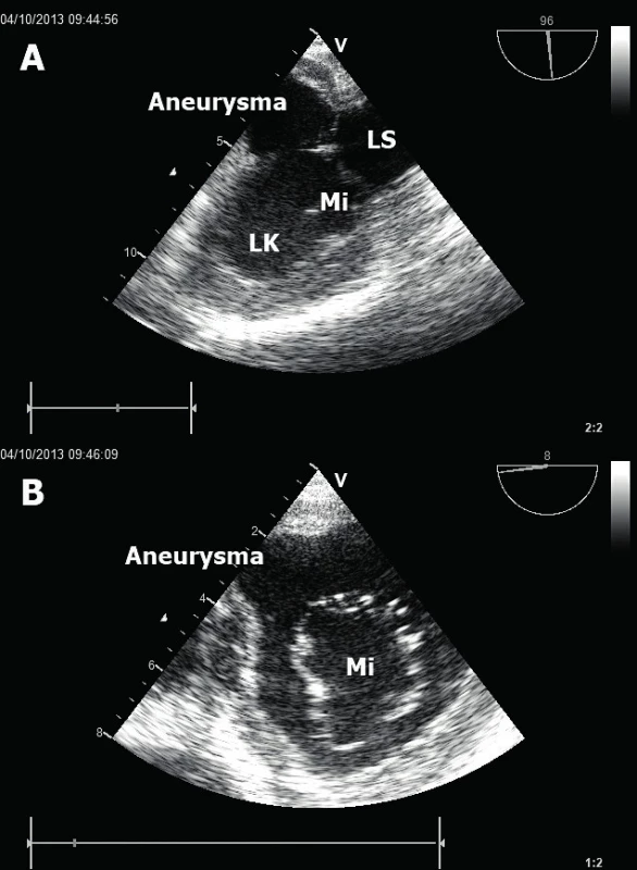 Posterobazální poinfarktové aneurysma LK