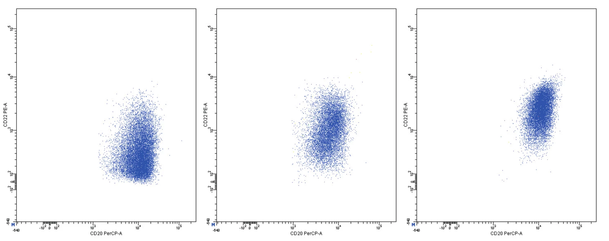 Variabilní exprese znaků CD20 a CD22, dvouparametrové dot plot diagramy, CD20 na vodorovné a CD22 na svislé ose, logaritmická škála exprese na obou osách