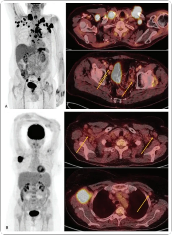 Příklady pacientů se dvěma typy lymfadenopatií, FDG-PET/CT MIP a fúzované PET/CT řezy v axiální rovině.