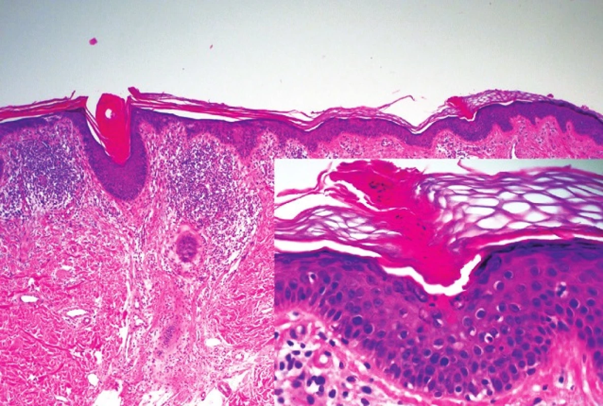 Histopatologický obraz kornoidní lamely u porokeratosis superficialis actinica z periferie léze
Detail kornoidní lamely tvořené vertikálním pruhem parakeratózy s dyskeratotickými a vakuolárně degenerovanými keratinocyty v epidermis pod ním (HE, 40 x, 200 x)