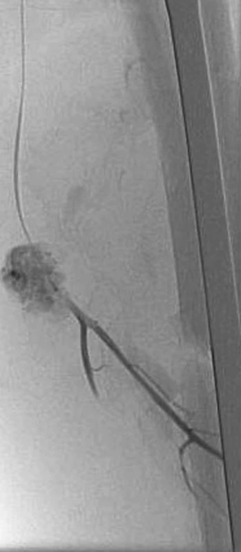 Angiografické zobrazení pseudoaneuryzmatu hluboké stehenní
tepny – naplněné pseodoaneuryzma Pic. 4. Angiographic view of the deep femoral artery pseudoaneurysm – the aneurysm is filled