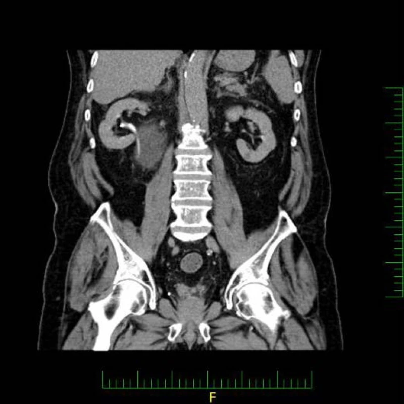 CT, koronární řez, vylučovací fáze: nedilatovaná pánvička pravé ledviny
Fig. 2. CT scan, coronal section, excretory phase: a non-dilated right renal pelvis