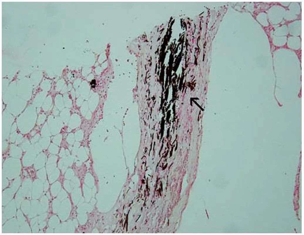 Histologický nález
Šipkou označeno ložisko kalcia (zvětšení 200krát, barvení podle Kossa).