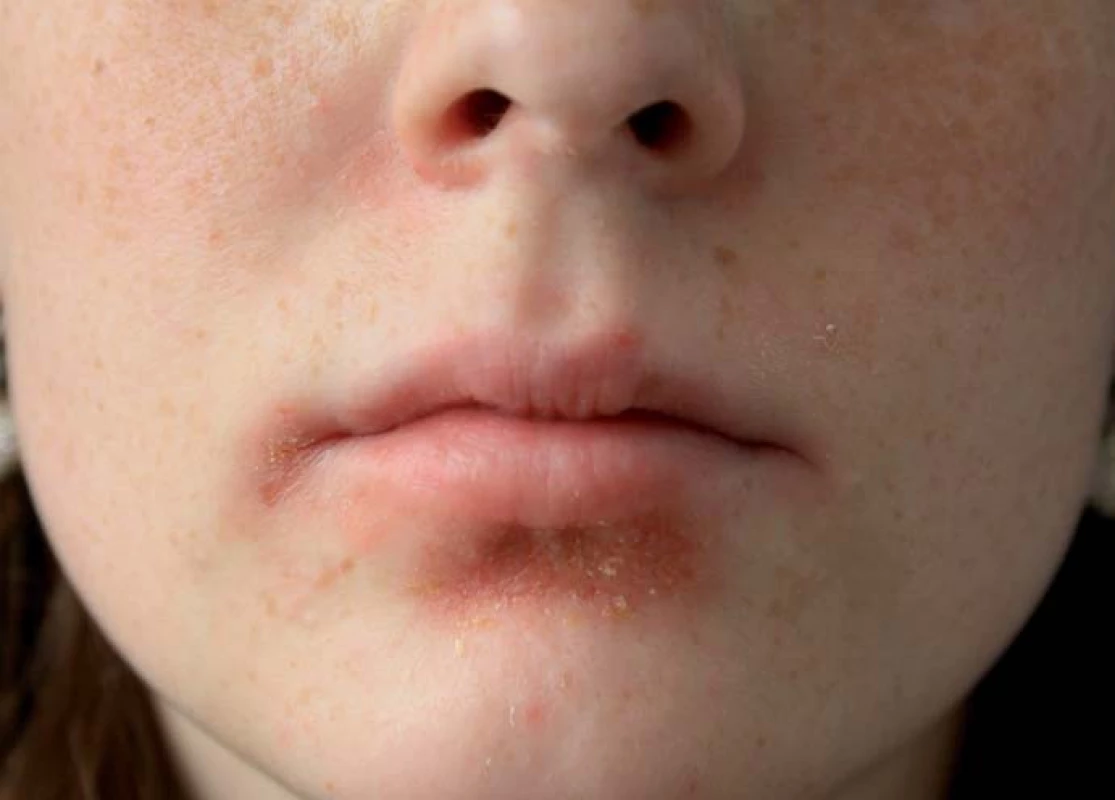 Atopická dermatitida s impetiginizací.
Fig. 10. Atopic dermatitis with impetiginization.