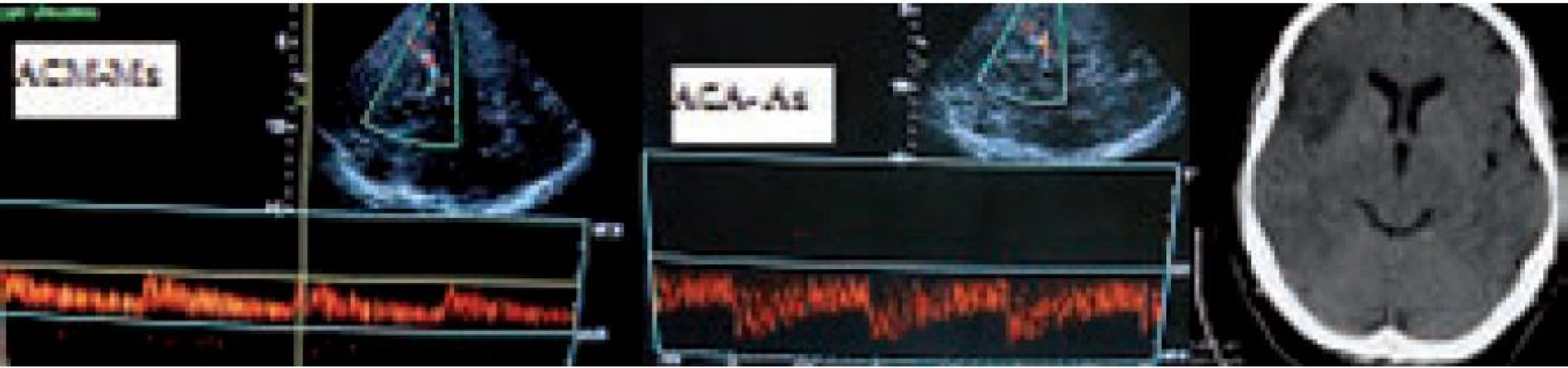 Demonstrace <i>flowdiversion</i> jako nepřímé známky okluze v distálním větvení ACM, kdy dojde k převrácení rychlostí toků. V ACM M1 před distální okluzí je tok snížen (TIBI 3) a v A1 (s M1 společně odstupující větev z terminální ACI) dojde k akceleraci toků, které jsou za normálních okolností nižší než v M1. Na CT snímku je patrný infarkt touto okluzí způsobený.