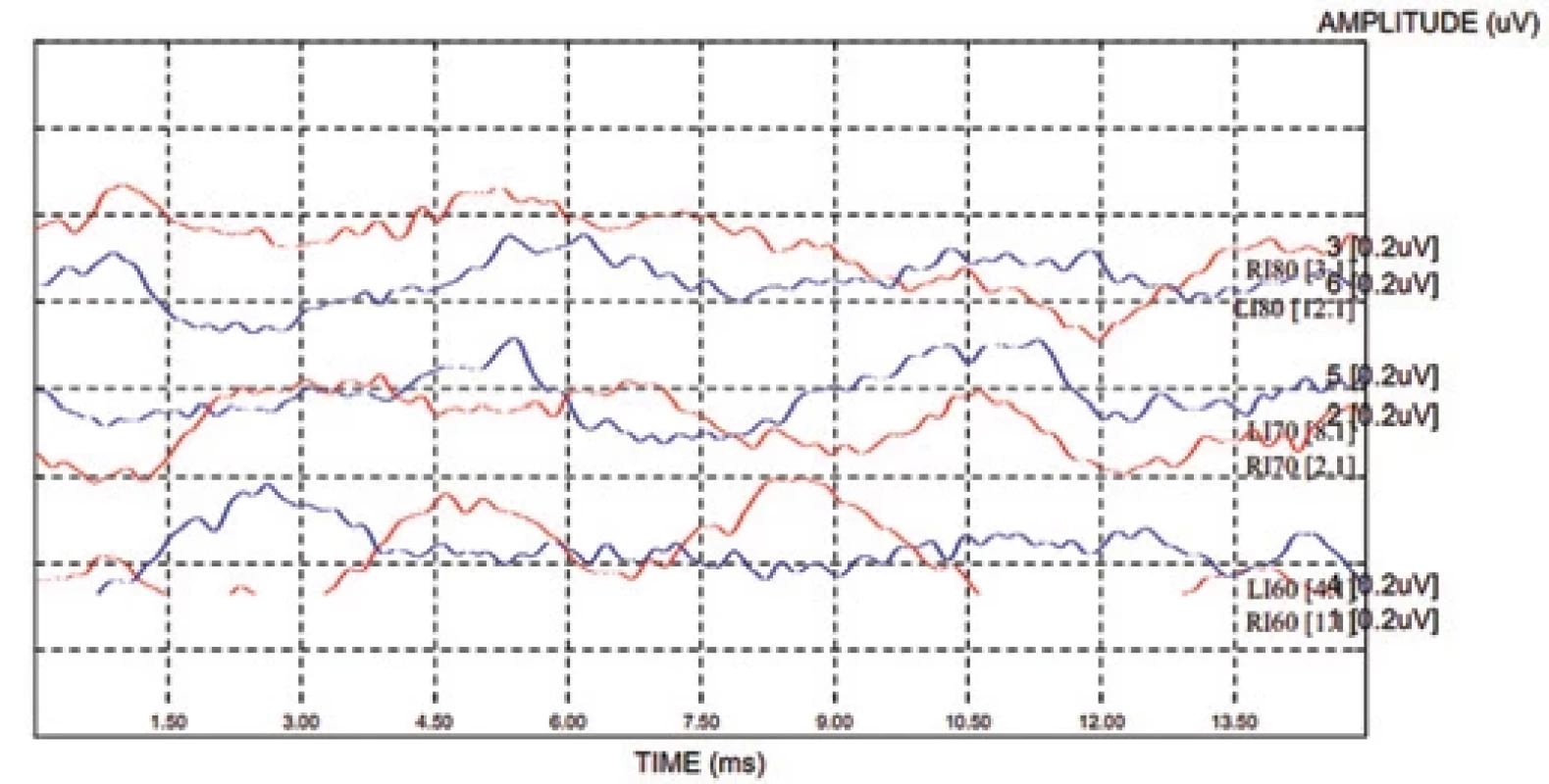 BERA, stimul: alternační click, 60–70–80 dB. Evokované kmenové odpovědi nevykazují synchronicitu, nelze posoudit latence.BERA, stimul: alternating click, 60–70–80 dB. There is no synchronicity in evoked brainstem responses. It is impossible
to detect latencies.