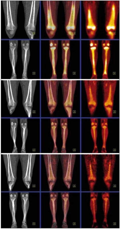 Srovnání akumulace fluorodeoxyglukózy při PET-CT vyšetření před léčbou, v průběhu léčby a po ukončení léčby. PET-CT dolních končetin opět u studií 8/2009, 4/2010, 8/2010. CT v režimu „low dose CT, kostní okno“, PET v barevné škále „Hot Body“, koronální řezy. Opět i zde je pokles metabolické aktivity ve skeletu dolních končetin.