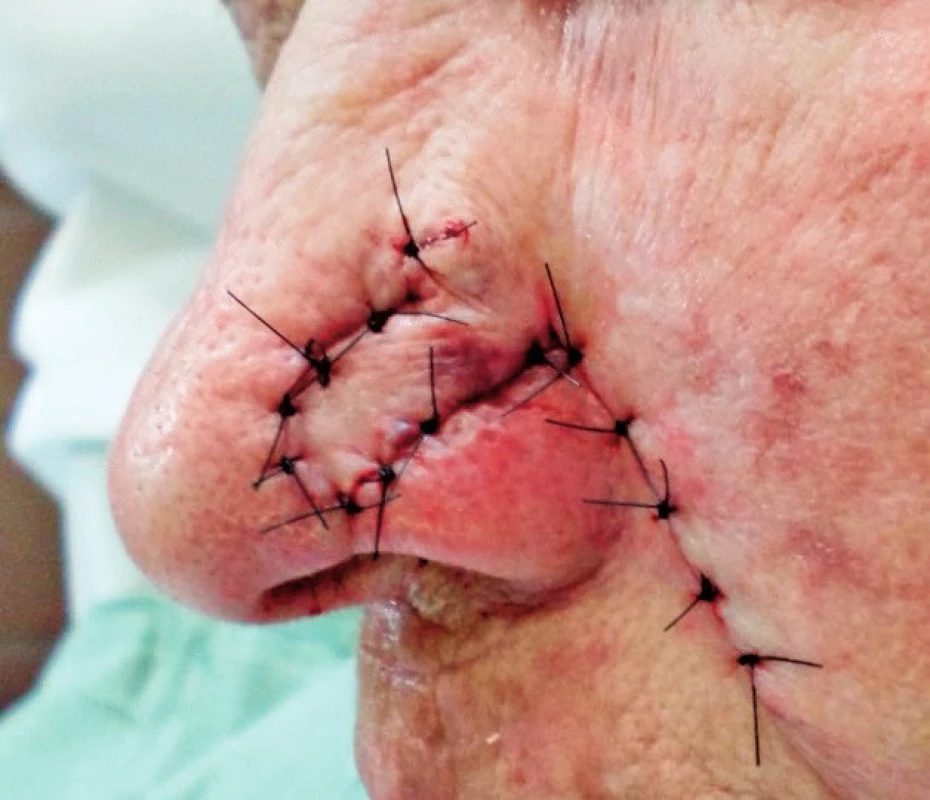 Transposition nasolabial flap