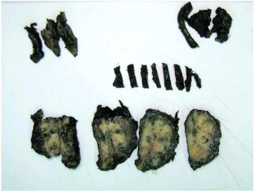 Materiál z radikální prostatektomie připraven ke kompletnímu zabločkování 
Fig. 2. Tissue from radical prostatectomy prepared for complete embedding