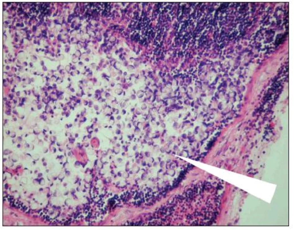 Metastáza karcinomu žaludku v lymfatické uzlině (označena šipkou). Optická mikroskopie, zvětšení 200x, barvení hematoxylin-eosin. S laskavým svolením prof. MUDr. R. Kodeta, CSc., přednosty Ústavu patologie a molekulární medicíny 2. LF UK a FN Motol.
Fig. 1. Gastric carcinoma mestastasis in a lymph node (arrow marked). Optic microscopy, enlargement 200x, hematoxylin-eosin staining. With kind approval by prof. MUDr. R. Kodet, CSc., Head of the Institute of Pathology and Molecular Medicine, 2nd Medical Faculty of the Charles University and Motol Faculty Hospital (LF UK and FN Motol).