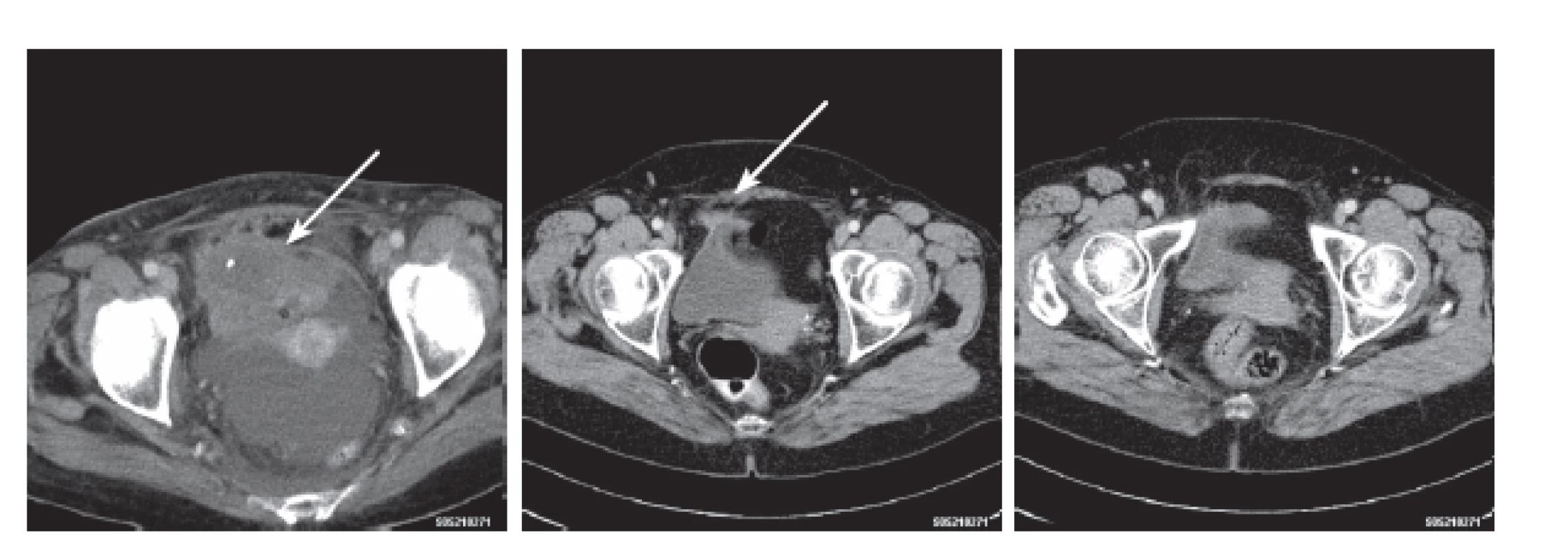 CT ložisko močového měchýře s kalcifikací – jeho regrese a vymizení
Fig. 2. Pathologic CT finding in urinary bladder – its regression and complete disappearance