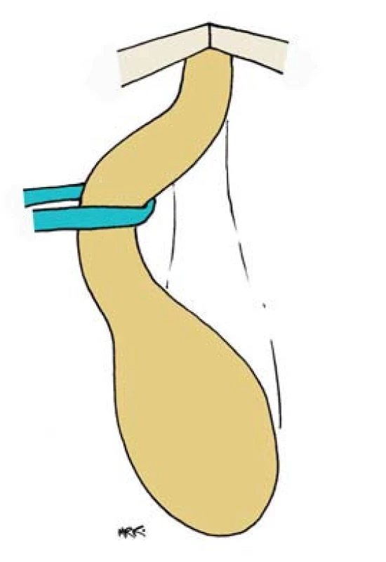 Moblizace uretry.