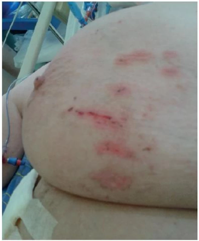 Exkoriace na prsu