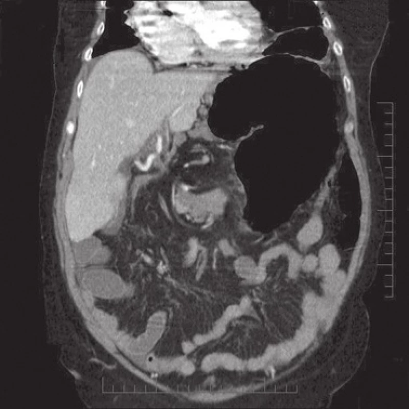 CT vyšetření, frontální řez
Fig. 2: Frontal CT scan