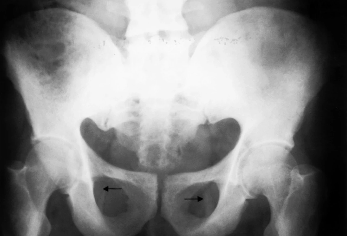 Fluoróza II.–III. štádium
Ossifikácia v lig. sacrotuberale obojstranne (šípky)