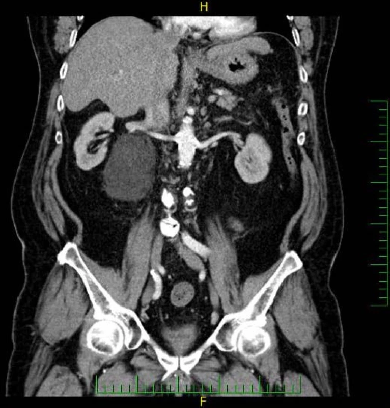 CT, koronární řez, arteriální fáze: neostře ohraničené ložisko lokalizované mediálně od pravé ledviny
Fig. 1. CT scan, coronal section, arterial phase: a lesion lacking well-circumscribed margins located medially to the right kidney
