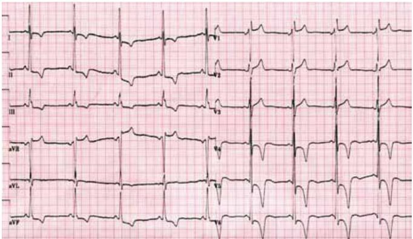 Elektrokardiogram mladého nemocného s Fabryho chorobou demontrující zkrácení PQ intervalu a voltážová kritéria hypertrofie levé komory doprovázená výraznými repolarizačními změnami.