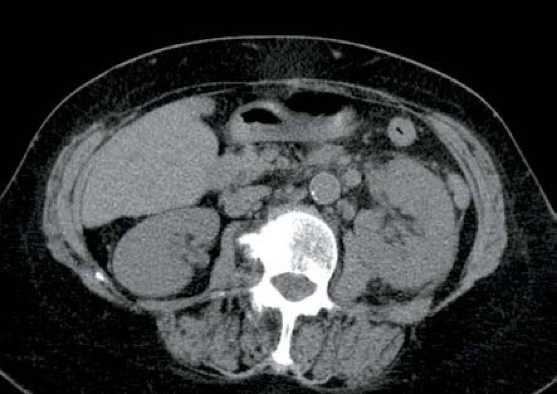 Mírný edém parenchymu levé ledviny s mírnými perirenálními změnami
Fig. 7. Slight oedema of left kidney parenchyma with slight changes in adjacent perirenal tissue