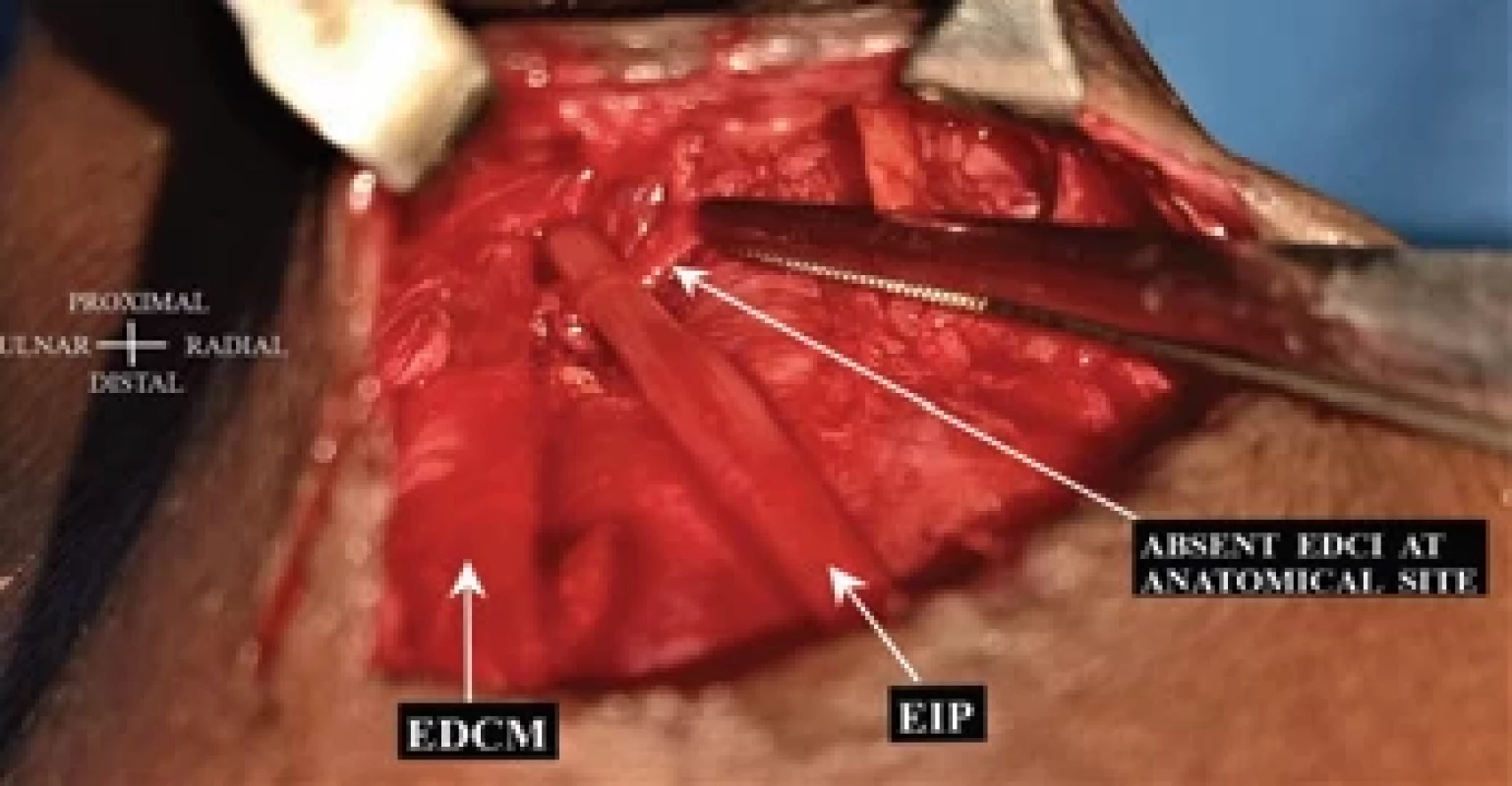 Showing normal anatomical location of extensor digitorum of index fi nger which is on radial side of EIP and is absent in our case.