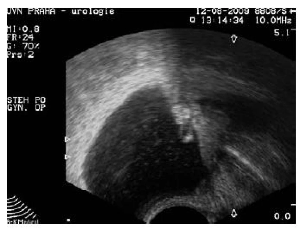 Kazuistika 2 – transvaginální ultrazvuk: granulom ve stěně močového měchýře 
a hyperechogenní část cizího materiálu v lumen měchýře
Fig. 4 Case report 2 – transvaginal ultrasound: granuloma in the wall of urinary bladder and hyperechogenous part of foreign material in the lumen of the bladder