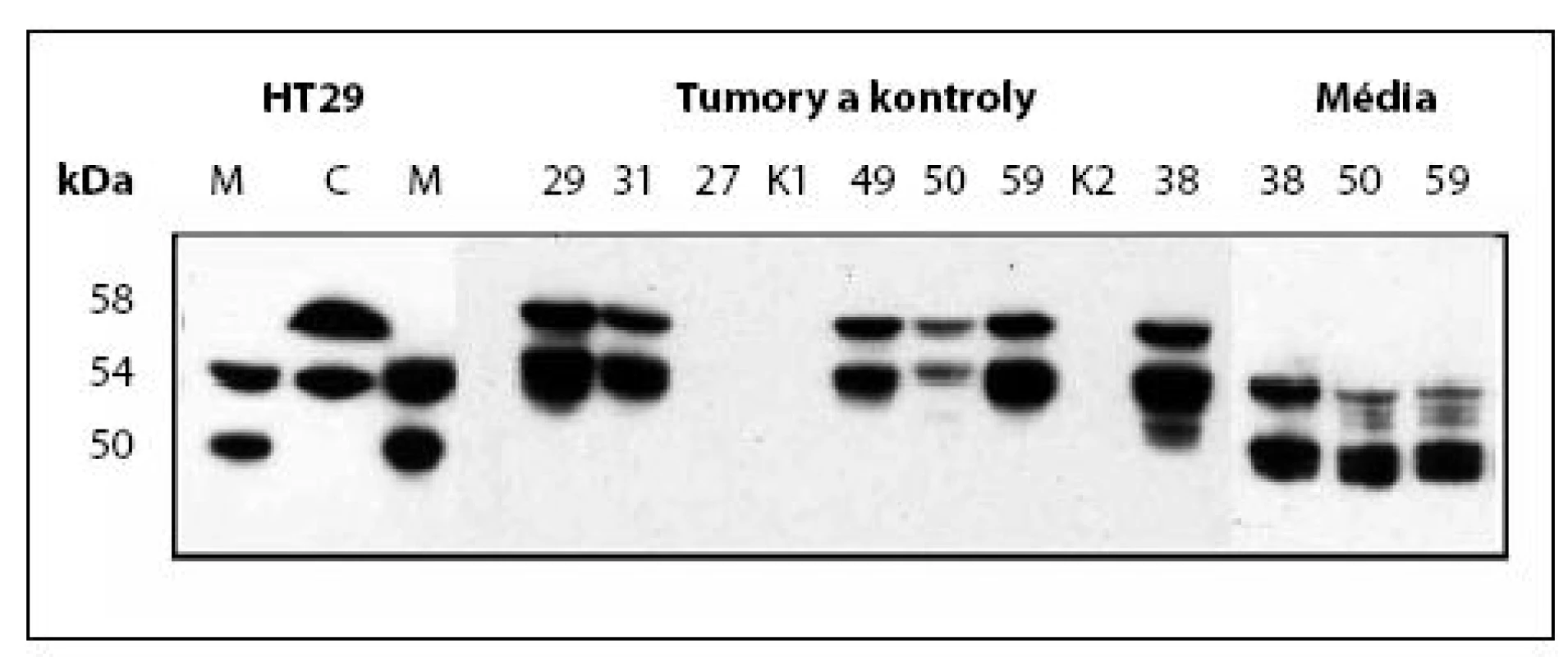 Western Blot, stanovení CA IX v kultivačním médiu nebo buněčném extraktu RCC a kontrolních tkání 
Fig. 2. Western blot analysis of CA IX in culture media or in extracts from cells, tumours and control tissues