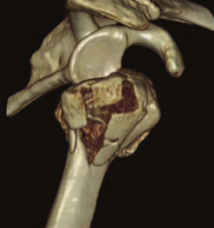 CT obraz implantace hemiartroplastiky. CT rekonstrukce