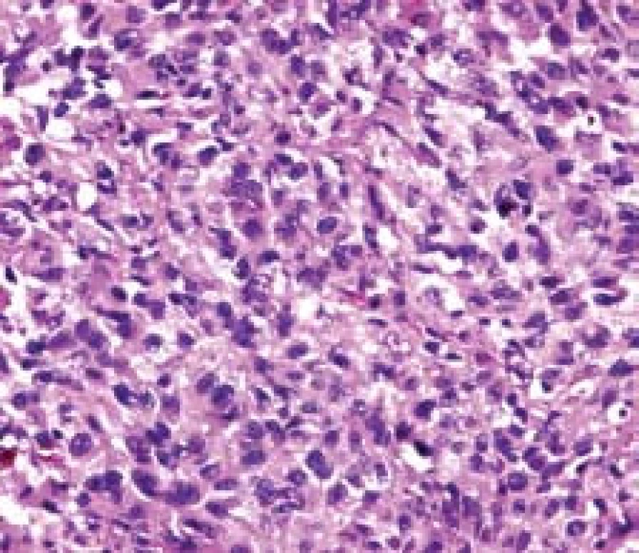 Při větším zvětšení jsou patrny polygonální buňky s jadernými atypiemi s hojným výskytem hnědého pigmentu. Barvení hematoxilin-eozin.
Fig. 6. Polygonal cells with nuclear atypia. Brown pigmentation. Hematoxilin- eosin satining.