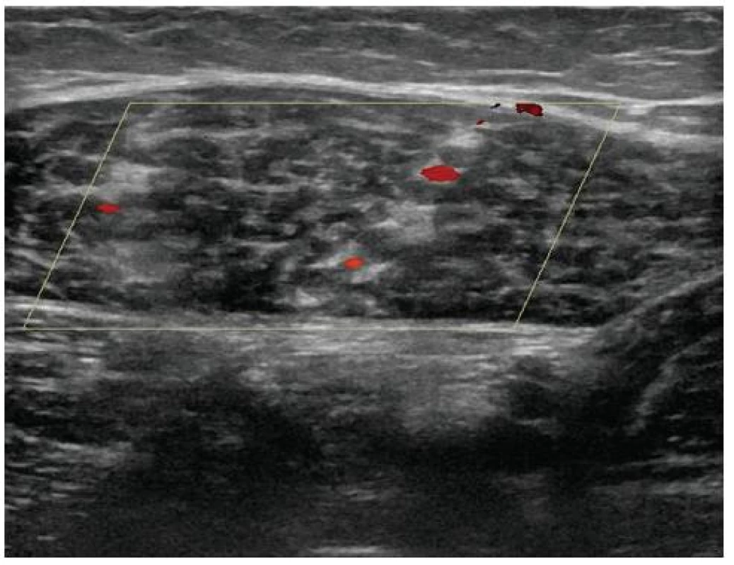 Flebotrombóza dvojice svalových žil m. gastrocnemius medialis