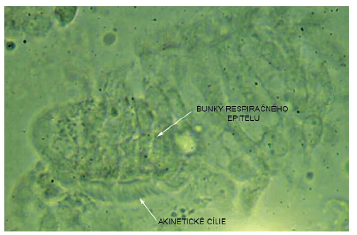 Akinetické cílie zachytené vysokorýchlostnou videomikroskopiou.
Fig. 3. High speed video microscopy image – akinetic cilia.