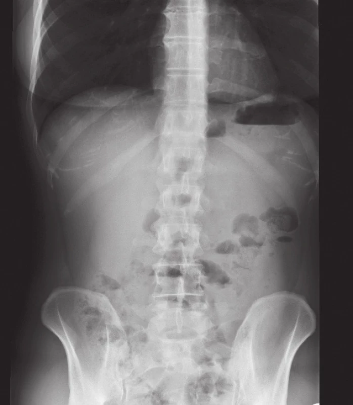 RTG obraz vnitřní kýly
Fig. 2: X-ray scan of internal hernia