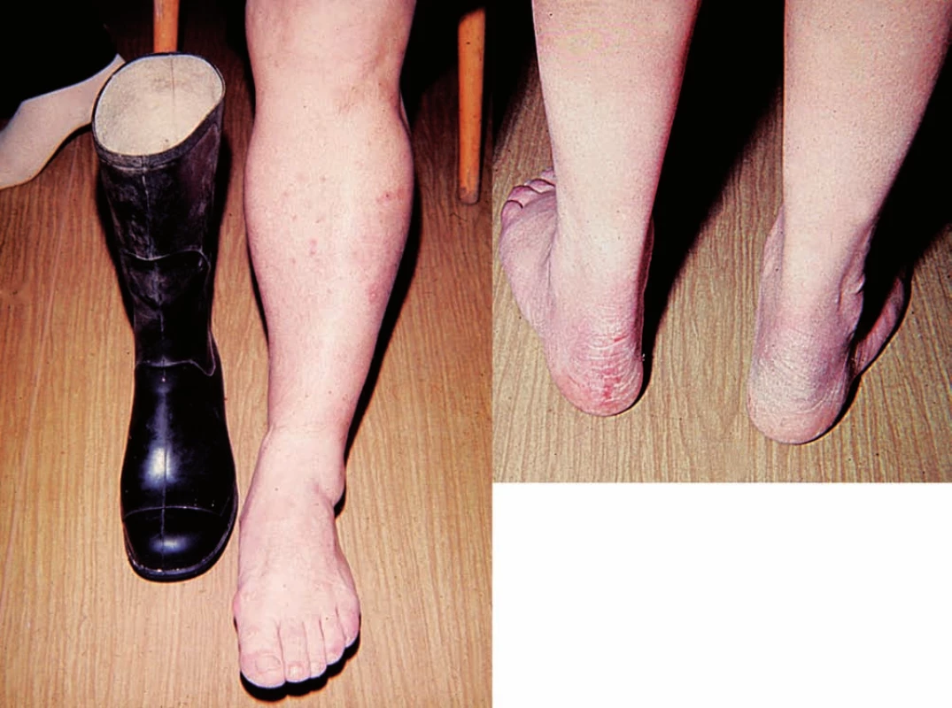 Eczema contactum – antioxidant IPPD (gumové holínky)