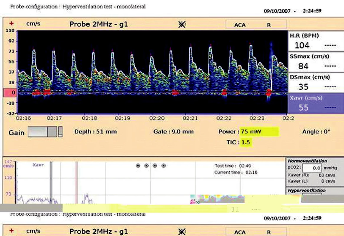 Hyperventilační test
V dolním okně záznam maximální průměrné rychlosti (Xavr) na a. cerebri media l.dx. při normoventilaci, následuje záznam maximální průměrné rychlosti (Xavr) při hyperventilaci 25 dechů/min s charakteristickým poklesem této rychlosti navozenou hypokapnií.