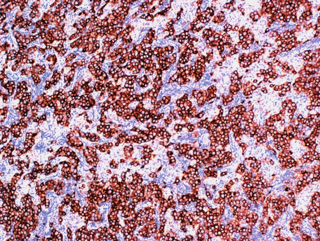 Imunohistochemický dôkaz placentálnej alkalickej fosfatázy v nádorových bunkách seminómu v metastatickom ložisku v retroperitoneu (zväčšenie 100×; PLAP)
Fig. 5. Immunohistochemical staining of placental alkaline phosphatase in neoplastic cells of seminoma in the retroperitoneal lymph node metastasis (magnification 100×; PLAP)