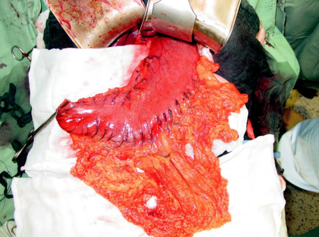 Resekce žaludku s omentem
Fig. 2. Resection of the stomach and the omentum