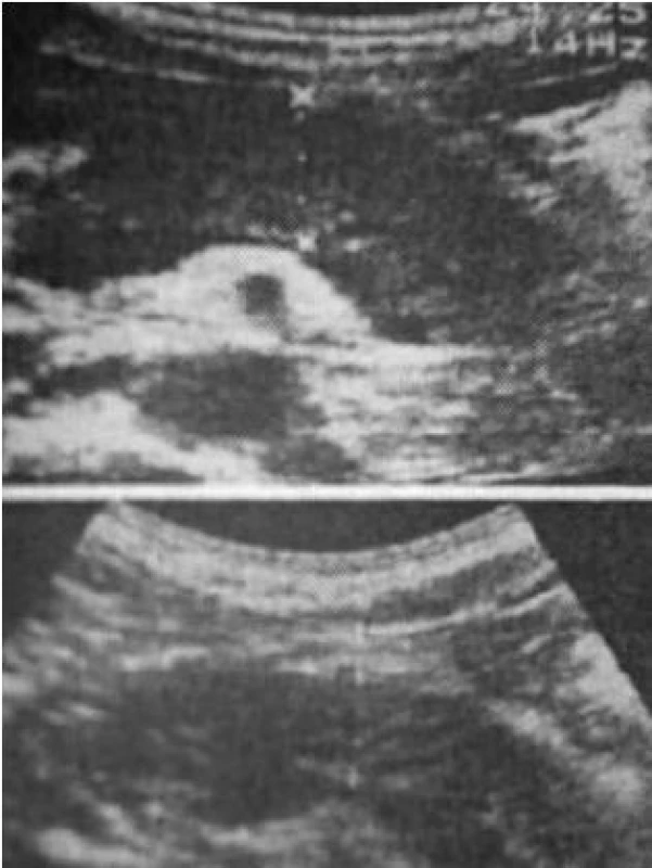 Obraz zvětšeného klobásovitého pankreatu před léčbou steroidy (horní obrázek) a po šestiměsíční terapii steroidy.
Fig. 3. Picture of enlarged tube-shaped pancreas prior to steroid treatment (upper picture) and following six months of steroid therapy.