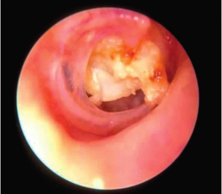 Cholesteatom destruující bubínek a středoušní kůstky, patrné hmoty keratinu.
Fig. 8. Cholesteatoma who destroy the tympanic membrane and middle ear ossicles.