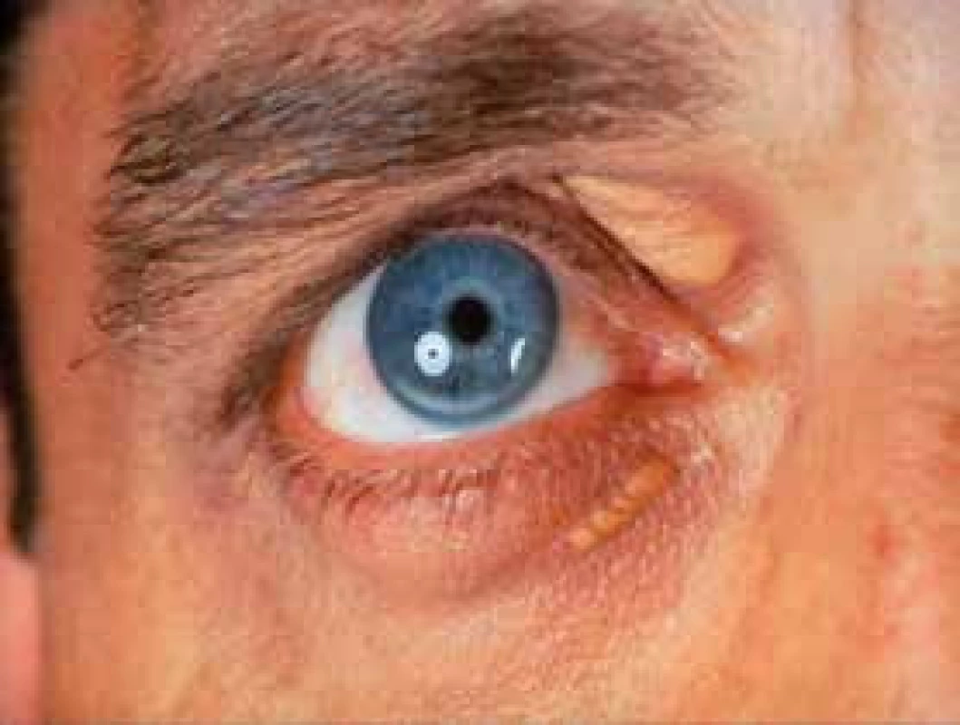 Arcus lipoides a xanthelasma palpebrae u FH (foto archiv autora)