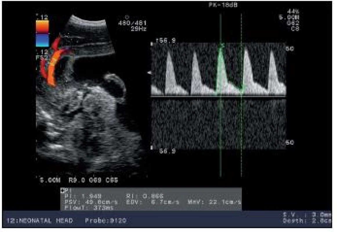 Dopplerovská krivka a. pericallosa u novorodenca s hydrocefalom pred drenážnym výkonom – alterácia bazálnych parametrov.
Fig. 3. Doppler curve and cisterna pericallosa in a newborn with hydrocephalus before the drainage intervention – alteration of basal parameters.