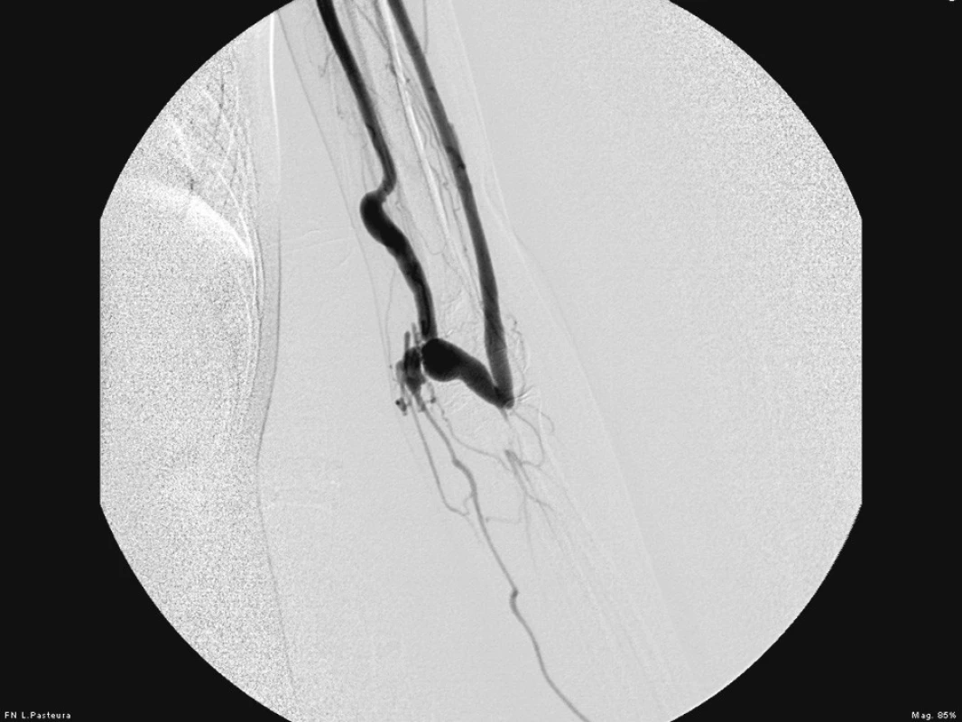 Angiografický nález brachiocefalickej fistuly
Fig. 3. Angiographic finding of a brachiocephalic fistula