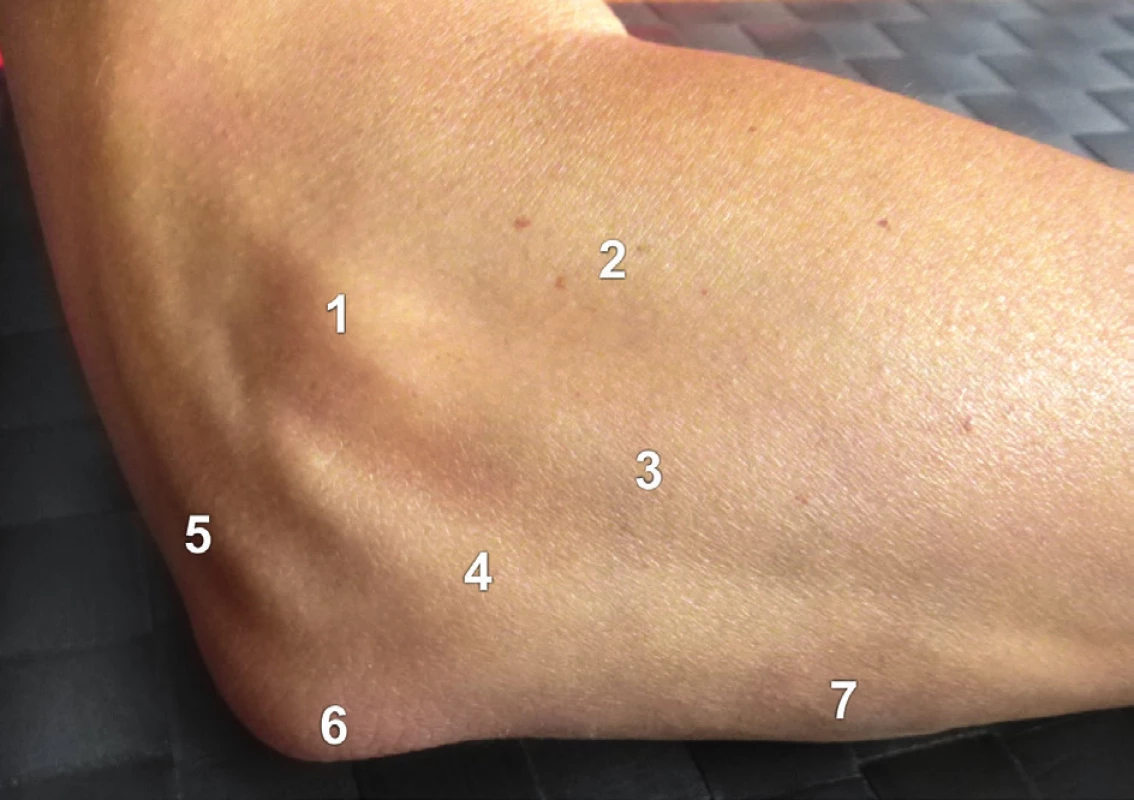 Reliéf zevní plochy loketního kloubu (pravá strana): 1 – epicondylus lateralis humeri, 2 – m. extensor digitorum, 3 – m. extensor carpi ulnaris, 4 – m. anconeus, 5 – šlacha m. triceps brachii, 
6 – olecranon, 7 – ulna.
Fig. 2: Relief of the lateral aspect of the elbow (right side): 1 – lateral epicondyle of humerus, 
2 – extensor digitorum, 3 – extensor carpi ulnaris, 4 – anconeus, 5 – triceps brachii tendon, 
6 – olecranon, 7 – ulna.