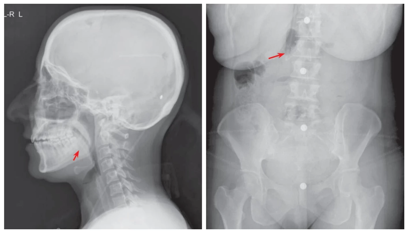 The exit of the catheter is shown radiologically (arrows).