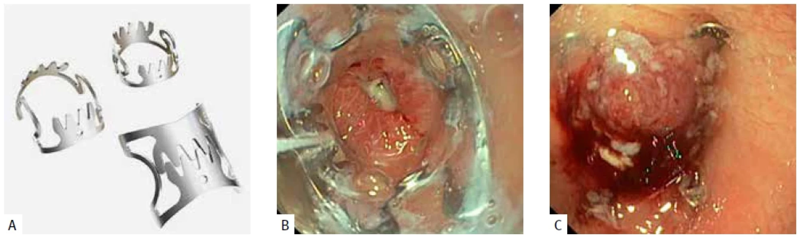 A) Klip OTSC (Ovesco Endoscopy AG, Tubingen, Germany). B) Nástavec s klipem přitlačený k ústí fistuly. C) Správně naložený OVESCO klip – uzavřené ústí fistuly.