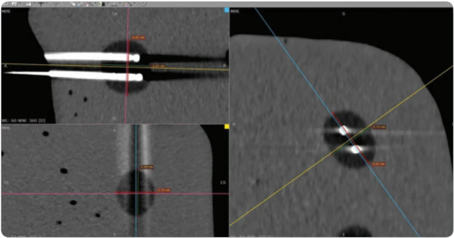 CT scan of the ice ball created using the double IceSphere™ needle confi guration after a 10-minute freezing cycle at 20% intensity.